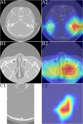 Deep learning for the screening of primary ciliary dyskinesia based on cranial computed tomography